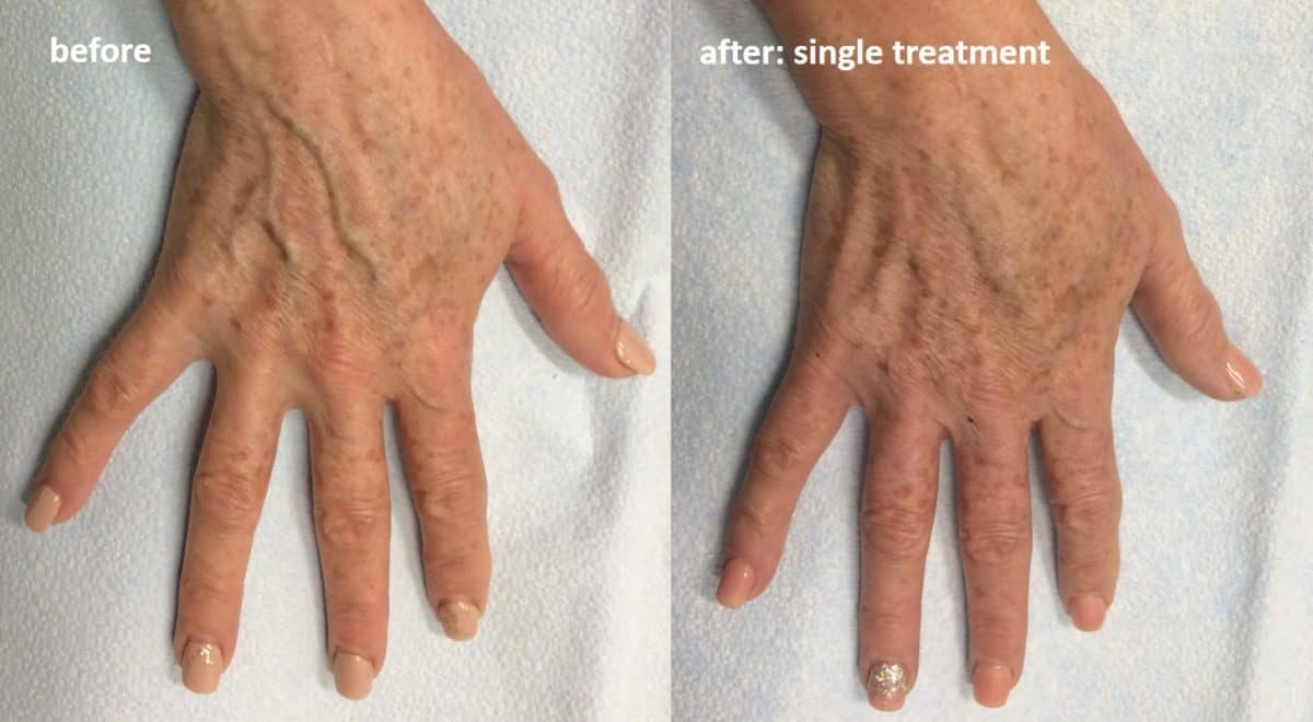 Handscaping™ Hand Vein Treatment - NorCal Vein Specialists