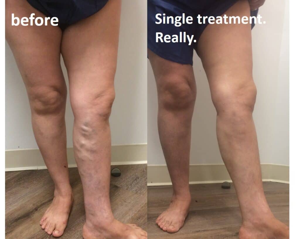 Varicose Vein Treatment in Sacramento, CA